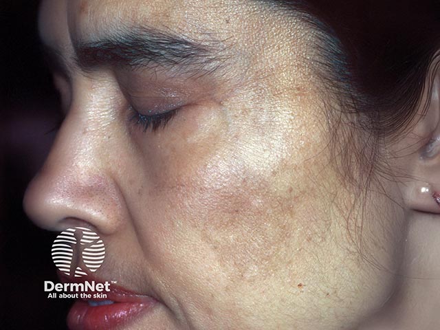 Oestrogen-induced facial melasma