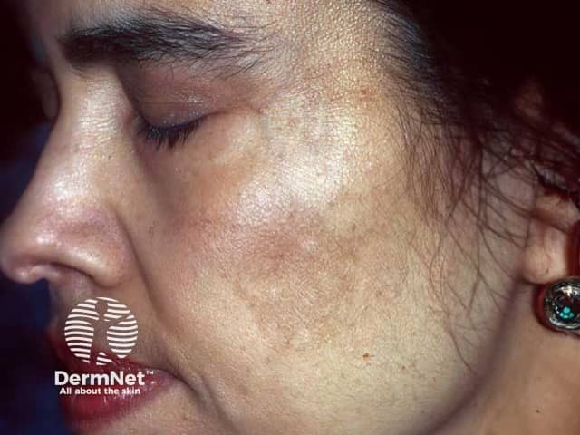 Oestrogen-induced facial melasma