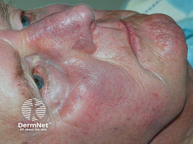 Blue facial and nasal pigmentation due to amiodarone