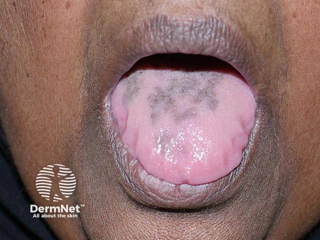 Pigmentation of the tongue from hydroxychloroquine administration