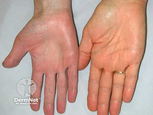 Yellow pigmentation of the palm due to mepacrine ingestion - it is often most visible on the face. The right palm is normal by contrast