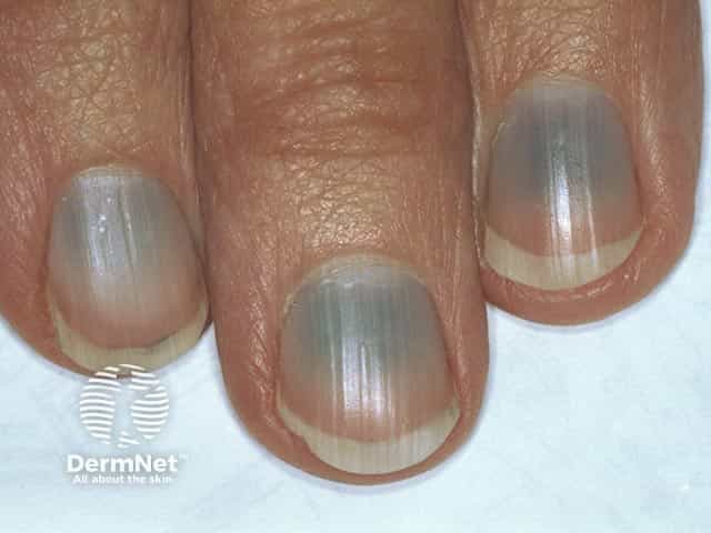 Blue nails due to minocycline