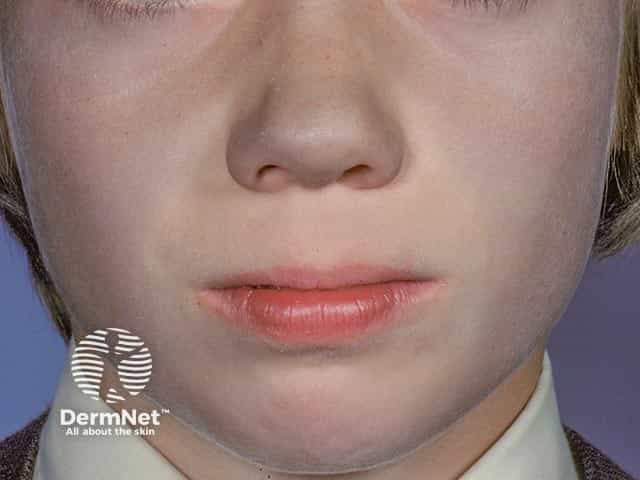 Blue pigmentation most evident on the nose due to amiodarone