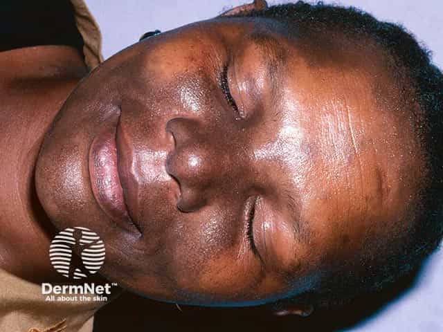 Minocycline facial pigmentation