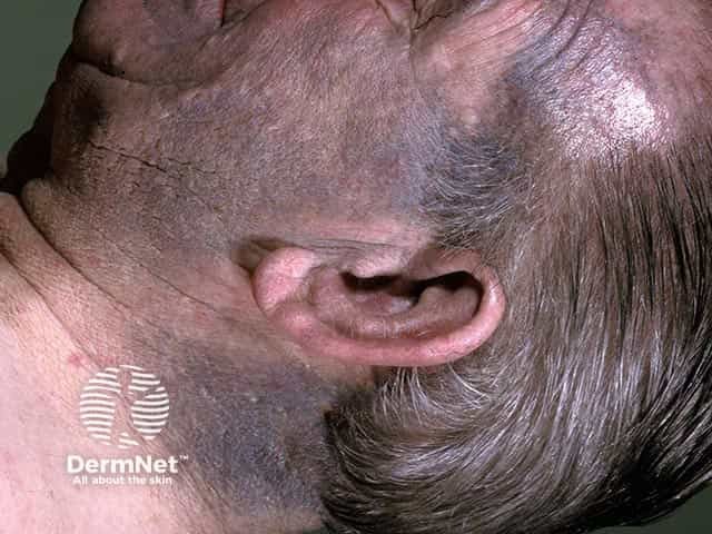 Minocycline facial pigmentation used for facial rosacea