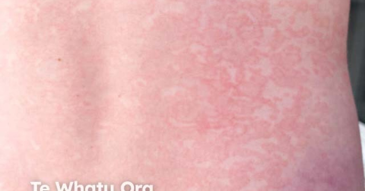 Drug induced urticaria image Drug induced urticaria image