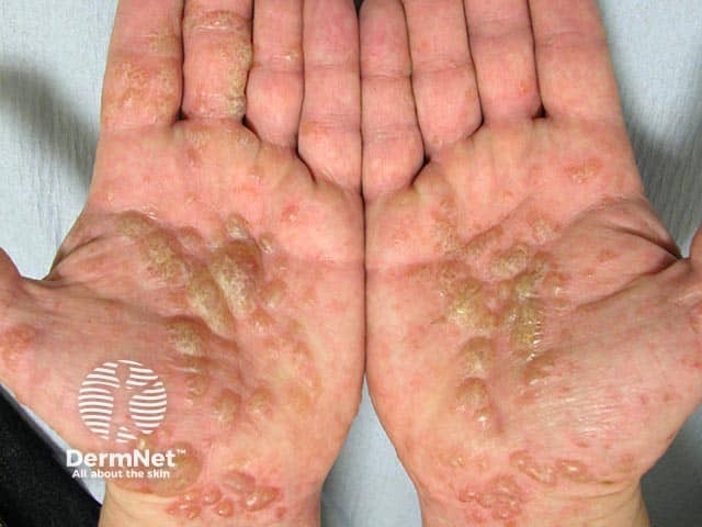 Eczema Blisters On Hands