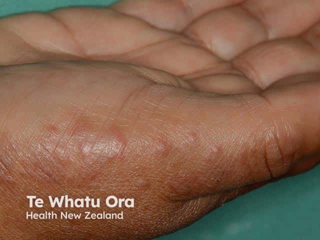 Vesicles over the palmar heel in vesicular eczema