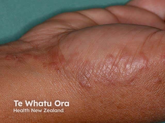 Vesicles on the palmar heel in pompholyx eczema