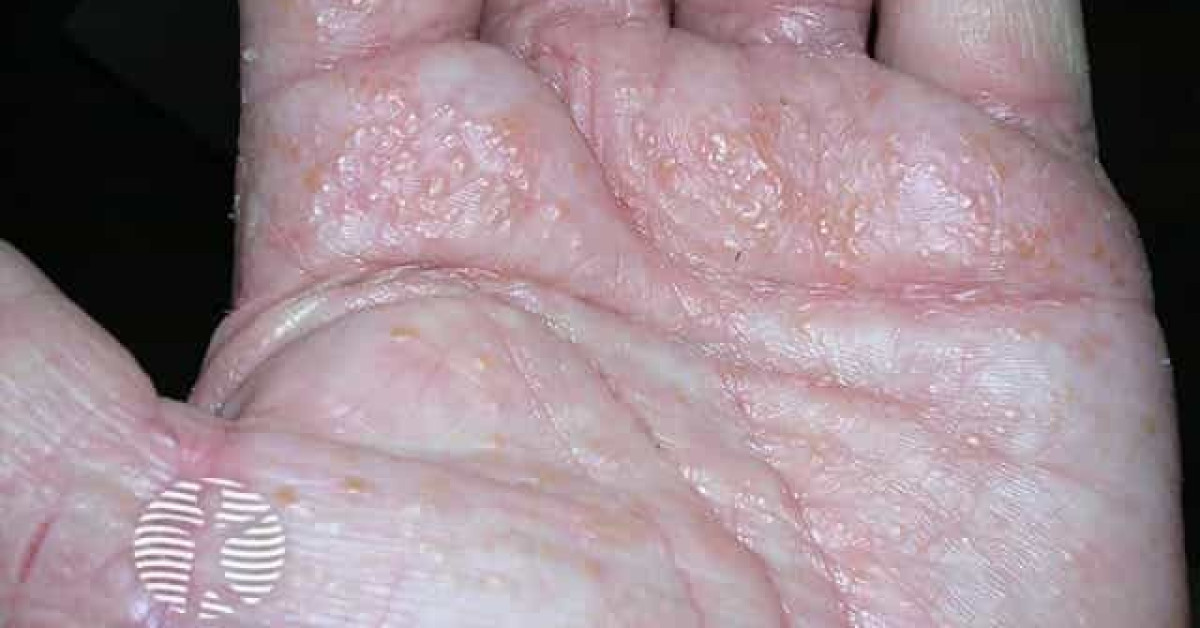 Dyshidrotic Eczema pompholyx Image Dyshidrotic Eczema pompholyx Image