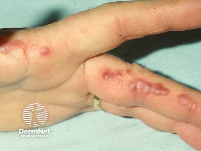 Vesicular eczema on the sides of the fingers