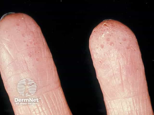 Vesicular eczema on the finger pulps