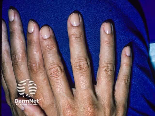 Vesicular eczema on the sides of the fingers