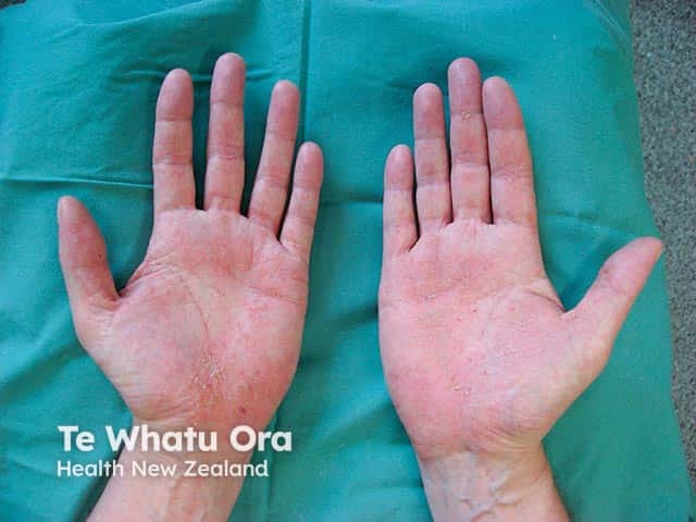 Microvesicular eczema on both palms