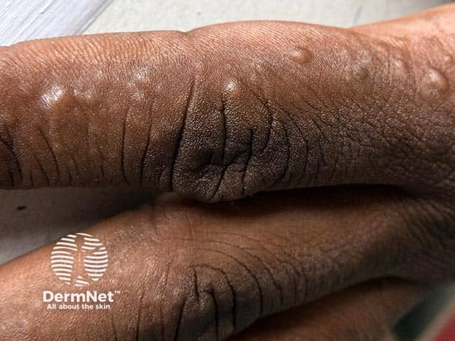 Vesicular eczema on the side of the finger in dark skin