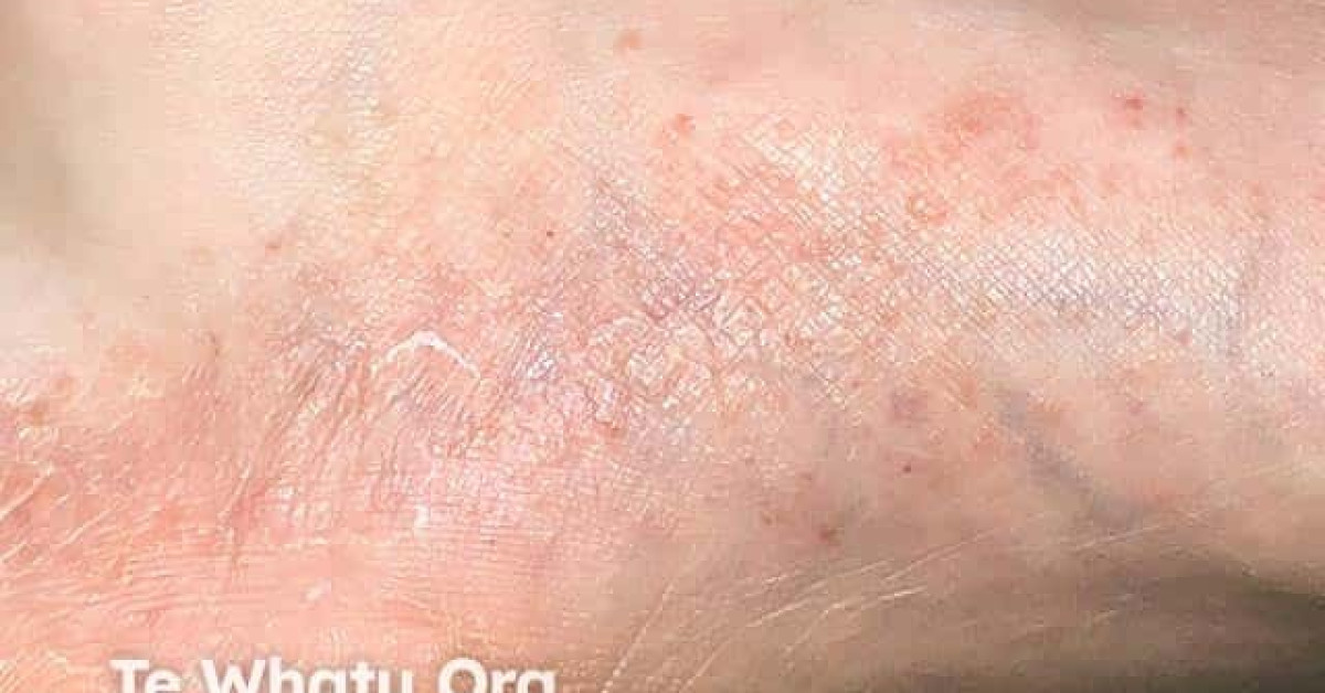 Dyshidrotic eczema (pompholyx) image