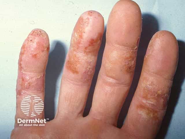 Vesicular eczema on the fingers