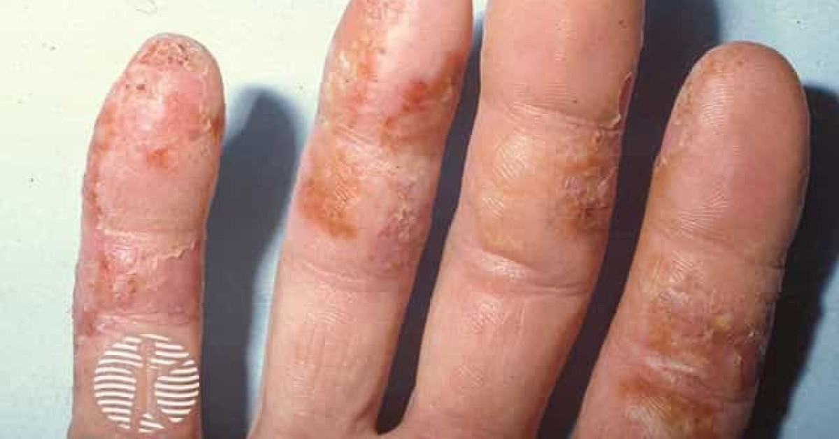 Dyshidrotic eczema (pompholyx) image