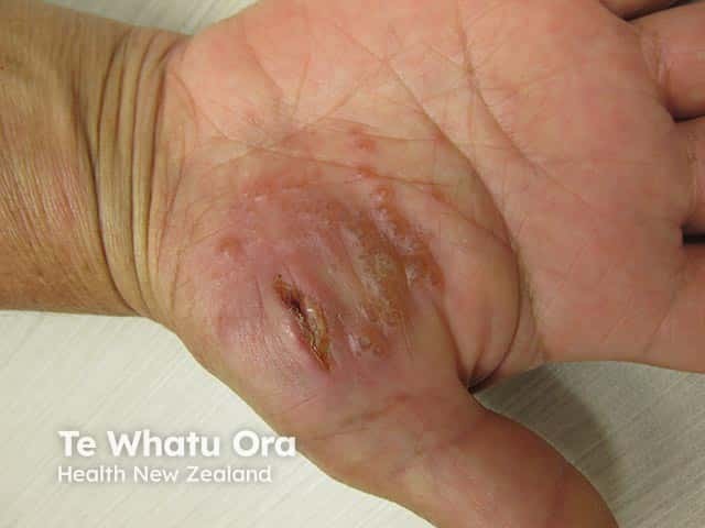 Vesicular eczema on the heel of the palm with fissuring and discharge suggesting infection