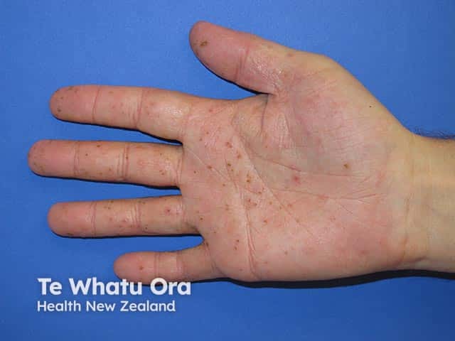 Microvesicular eczema on the palm