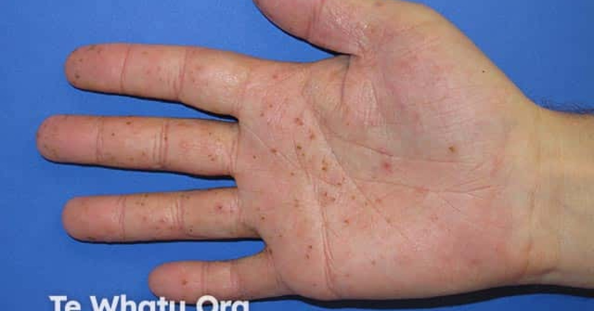 Dyshidrotic Eczema pompholyx Image Dyshidrotic Eczema pompholyx Image