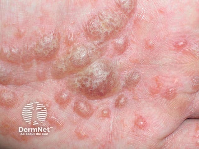 Tapioca or frog spawn-like blisters in pompholyx eczema of the palm