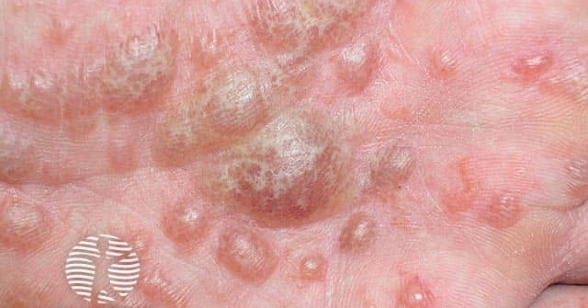 Uillinn Eczema Dyshidrotic Efficacy And Tolerance Of Upadacitinib In Uillinn Eczema Dyshidrotic Efficacy And Tolerance Of Upadacitinib In