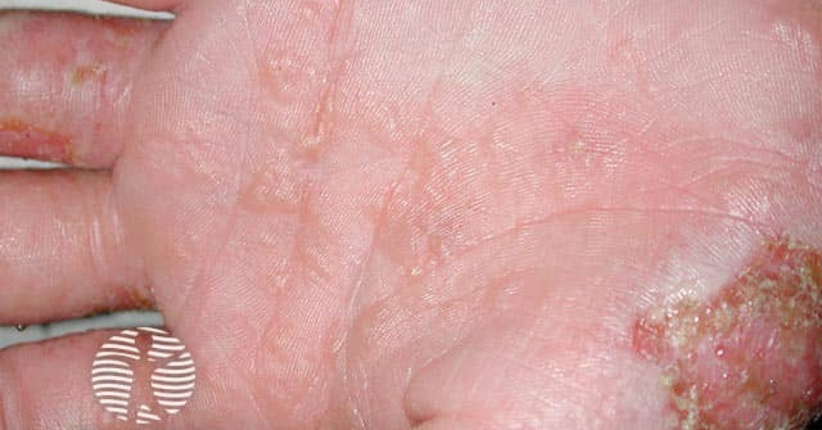 Dyshidrotic Eczema Pompholyx Background Etiology Of
