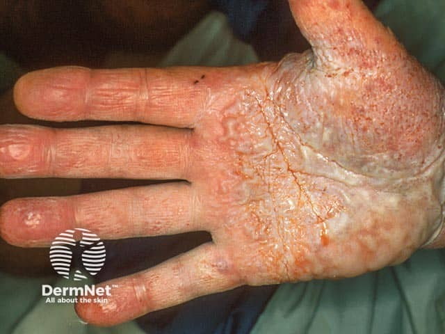 Severe pompholyx eczema of the palm with confluent blisters and maceration of the overlying thick palmar epidermis
