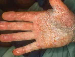 Dyshidrotic eczema (pompholyx)