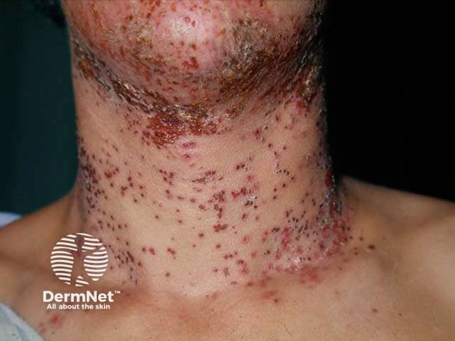 Monomorphic erosions due to eczema herpeticum in HIV infection