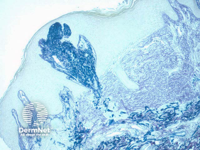 Elastin can be seen being eliminated transepidermally - typical of elastosis perforans serpiginosa