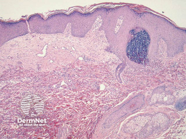 Altered elastin being engulfed by the epidermis prior to transepidermal elimination in elastosis perforans serpiginosa