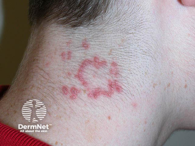 Papules arranged in an annular distribution with overlying scale on the neck due to elastosis perforans serpiginosa