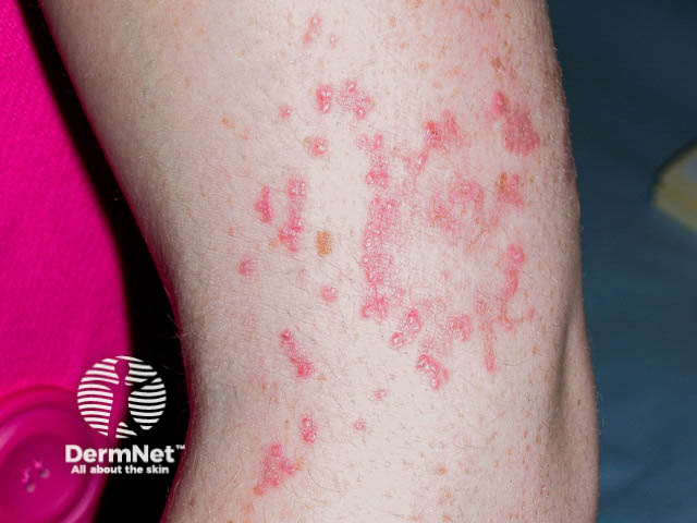 Small scaly papules on the arm arranged in an annular and serpiginous distribution - elastosis perforans serpiginosa