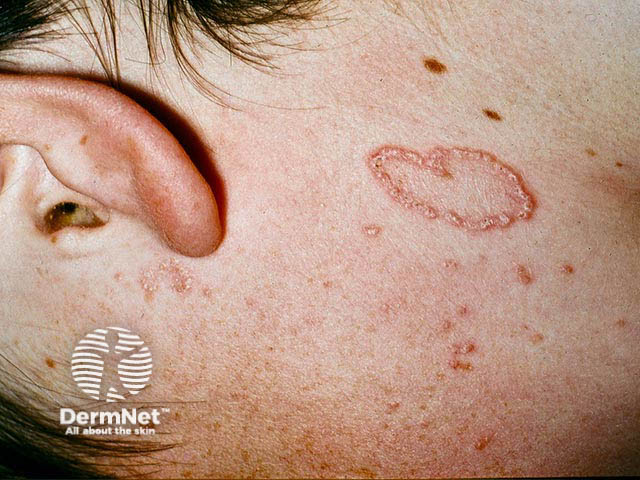 Crusted papules in an annular distribution on the neck due to elastosis perforans serpiginosa