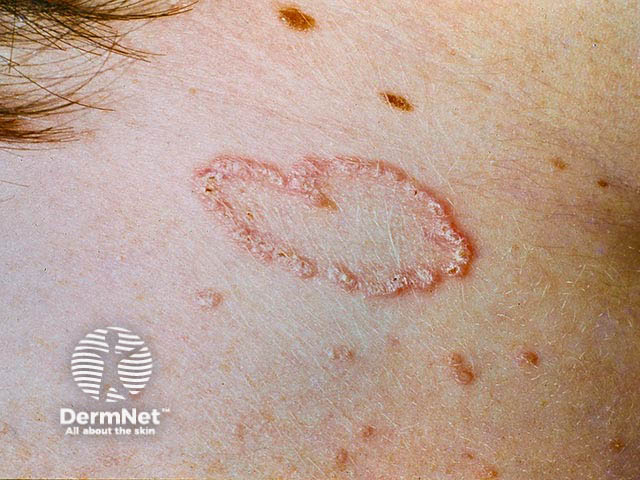 Crusted papules in an annular distribution on the neck due to elastosis perforans serpiginosa