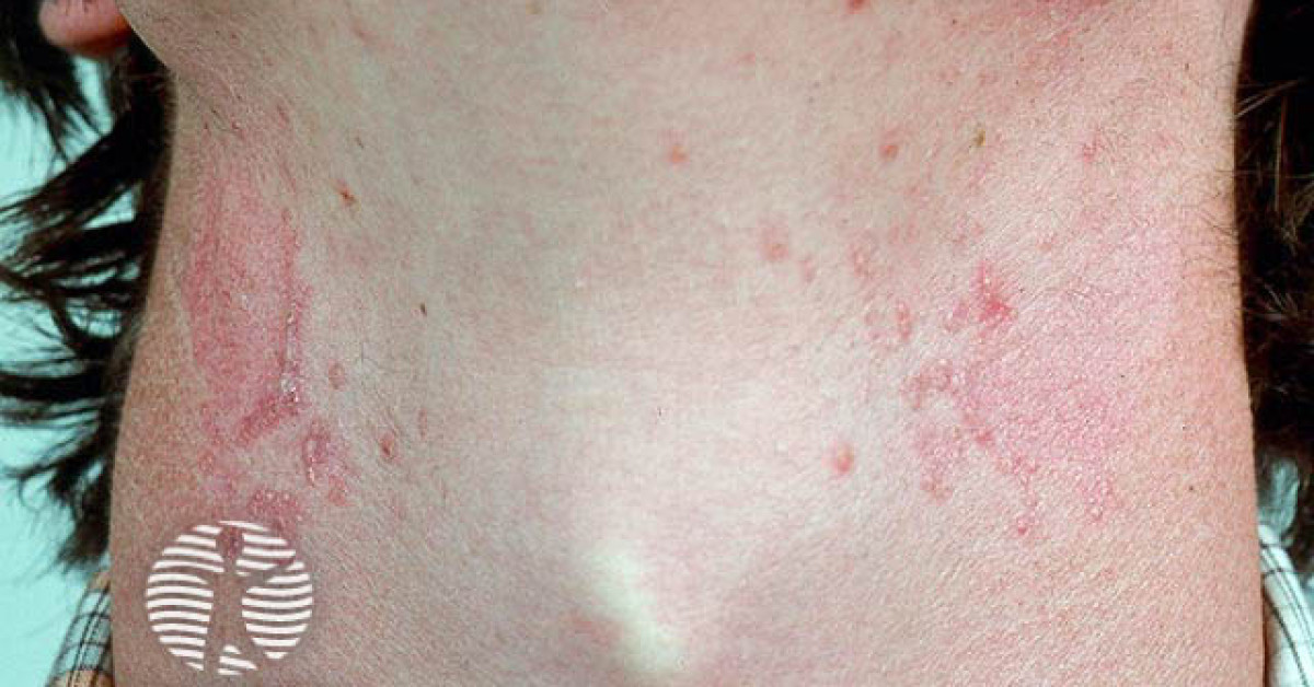 Elastosis perforans serpiginosa image