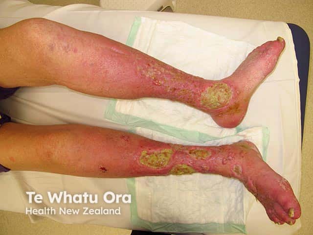 Mixed venous insufficiency and lymphoedema resulting in ulcers, warty hyerkeratosis, and nodular lesions - elephantiasis nostras verrucosa