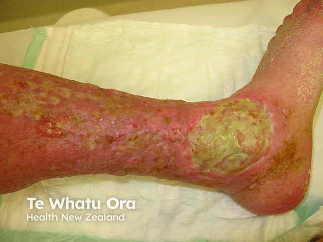 Ulceration over the medial malleolus with nodules, oedema, fibrosis and hyperkeratosis