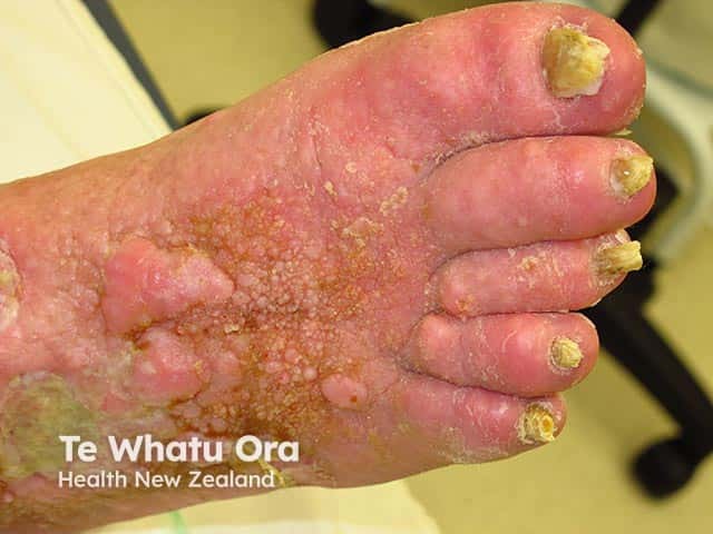 Mixed venous insufficiency and lymphoedema resulting in ulcers, warty hyerkeratosis, and nodular lesions - elephantiasis nostras verrucosa