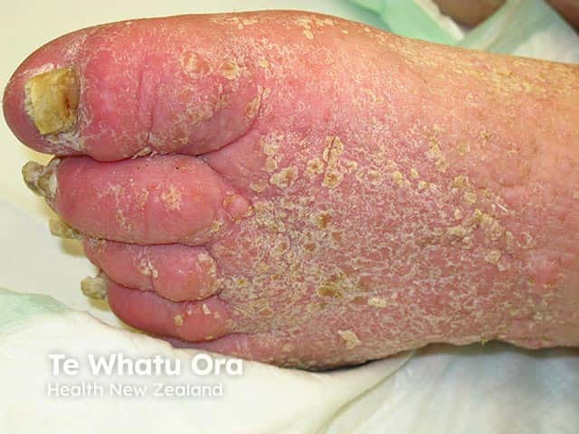 Warty hyperkeratosis over a lymphoedematous dorsal foot - elephantiasis nostras verrucosa