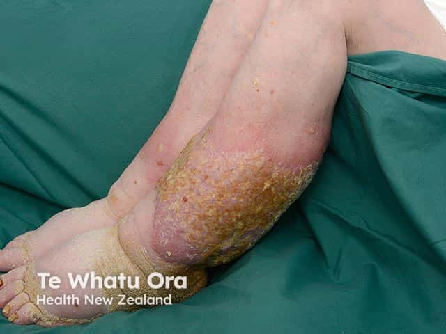 Warty and hyperkeratotic changes arising in chronic lower leg lymphoedema - elephantiasis nostras verrucosa