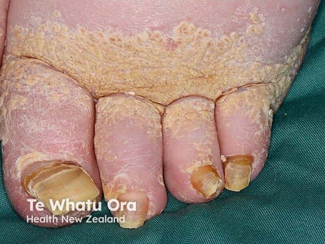 Lymphoedema over the toes with overlying hyperkeratosis in ENV