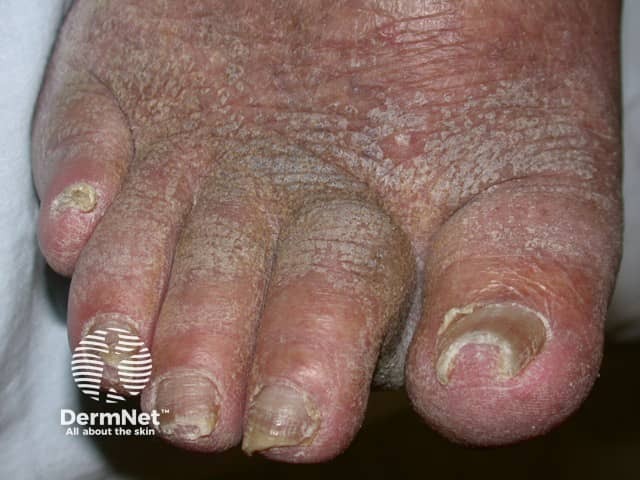 Lymphoedematous toes with overlying warty changes - Kaposi-Stemmer sign was positive