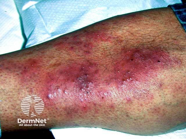 Eosinophilc folliculitis on the leg in HIV infection