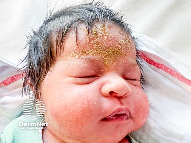 Neonatal eosinophilic pustulosis - pustules are still evident on the cheeks while forehead lesions have already crusted