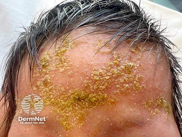 Pustules have ruptured and there is now extensive crusting in neonatal eosinophilic pustular folliculitis