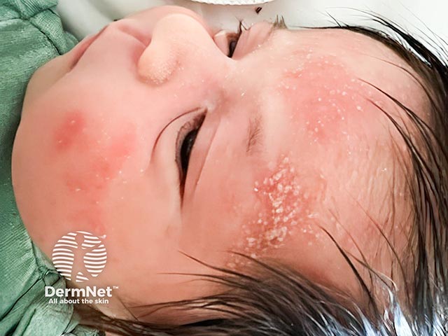 Pustules over the cheek and forehead in early neonatal pustular folliculitis