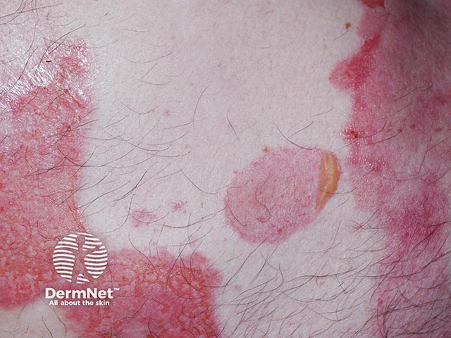 Large flaccid blisters on the shin due to epidermolysis bullosa acquisita